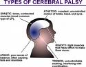 Cerebral Palsy Treatment Cure, Cerebral Palsy Neuro Acupuncture Treatment Centre, Cerebral Palsy Herbal Herbs Medicine Treatment